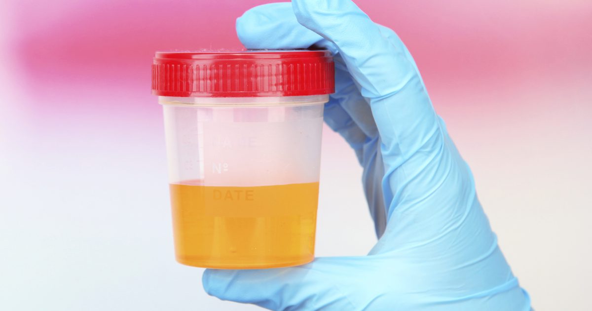 ما الذي يسبب البول البرتقالي وارتفاع اختبارات وظائف الكبد؟