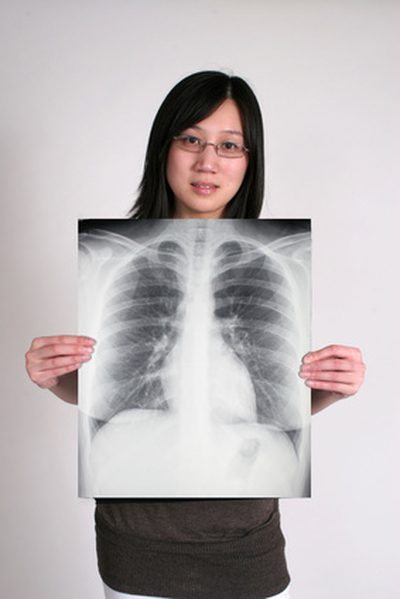 Was Ursachen Narbenbildung der Lunge?