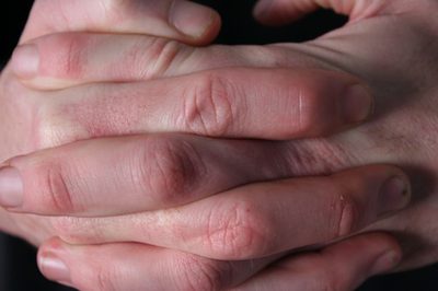 Что вызывает кожу, чтобы очистить от кончиков пальцев?