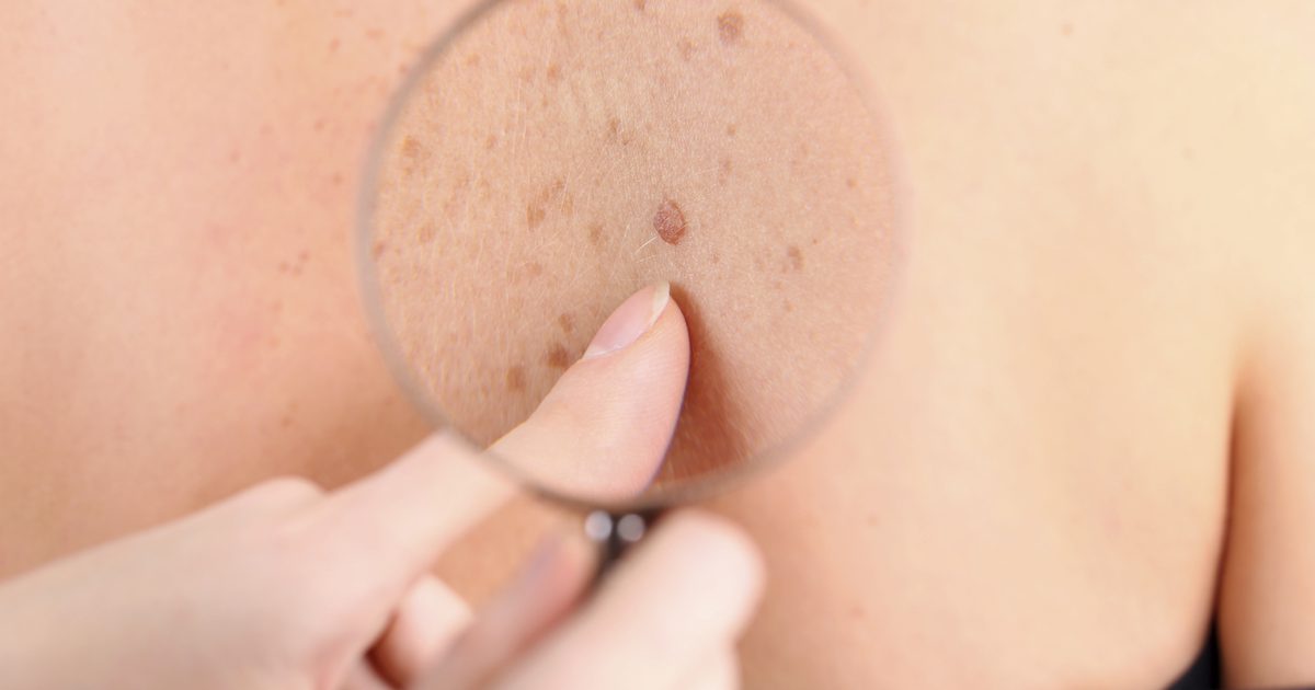 Co powoduje owrzodzenia skóry?