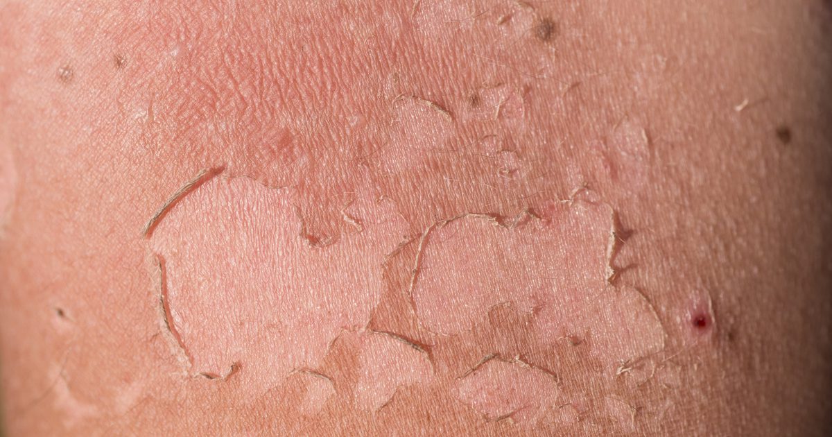 Hvorfor skiller huden efter solskoldning?