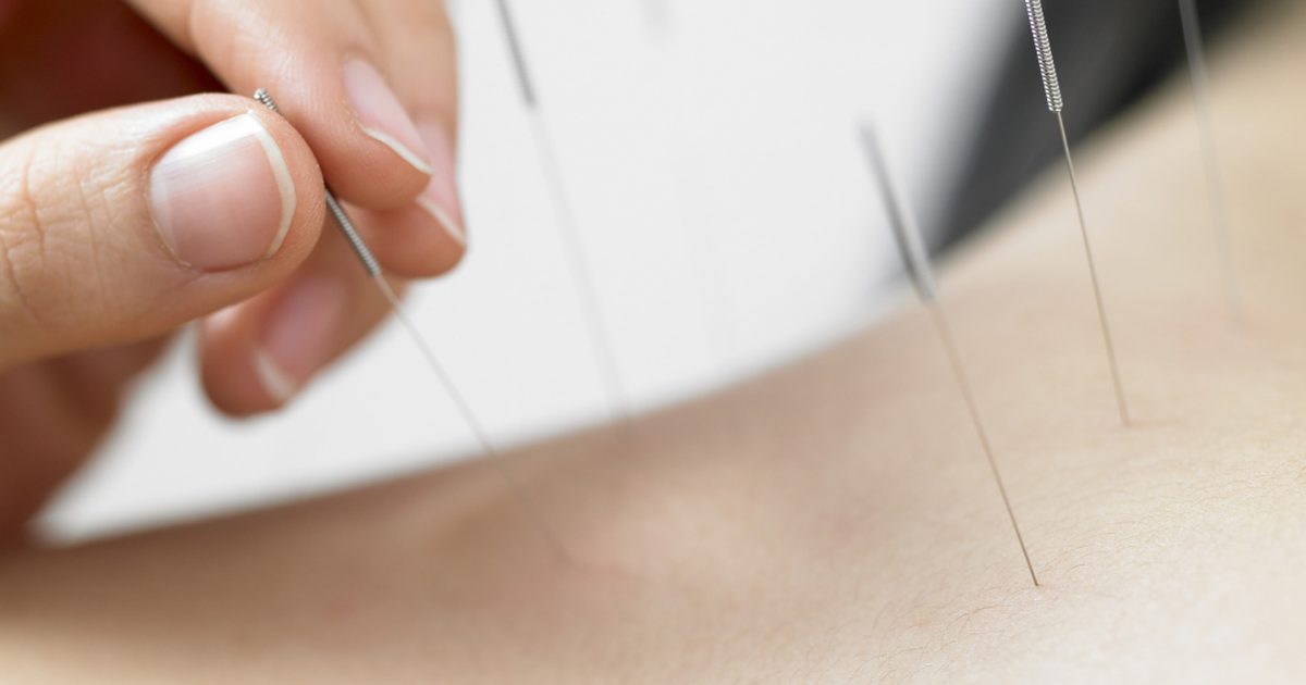 Akupunktur für Narben-Therapie