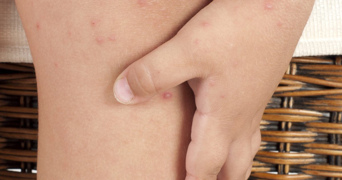 Allergische Reaktionen mit Hautflecken