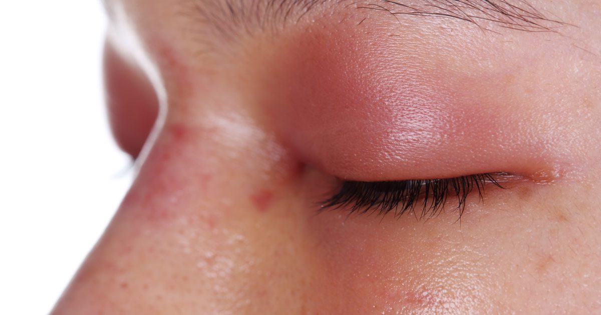 Alergična reakcija, ki povzroča, da se oči vrtijo