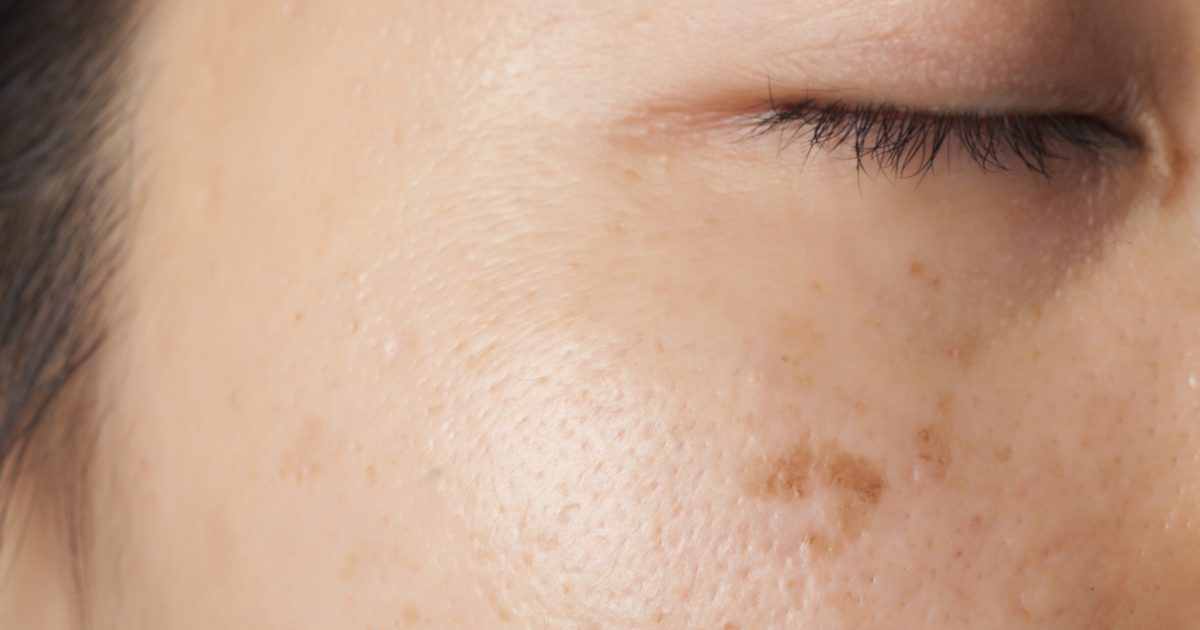 Zuiveringszout voor acne littekens en rimpels