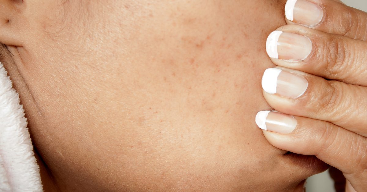 Den beste måten å fjerne acne arr