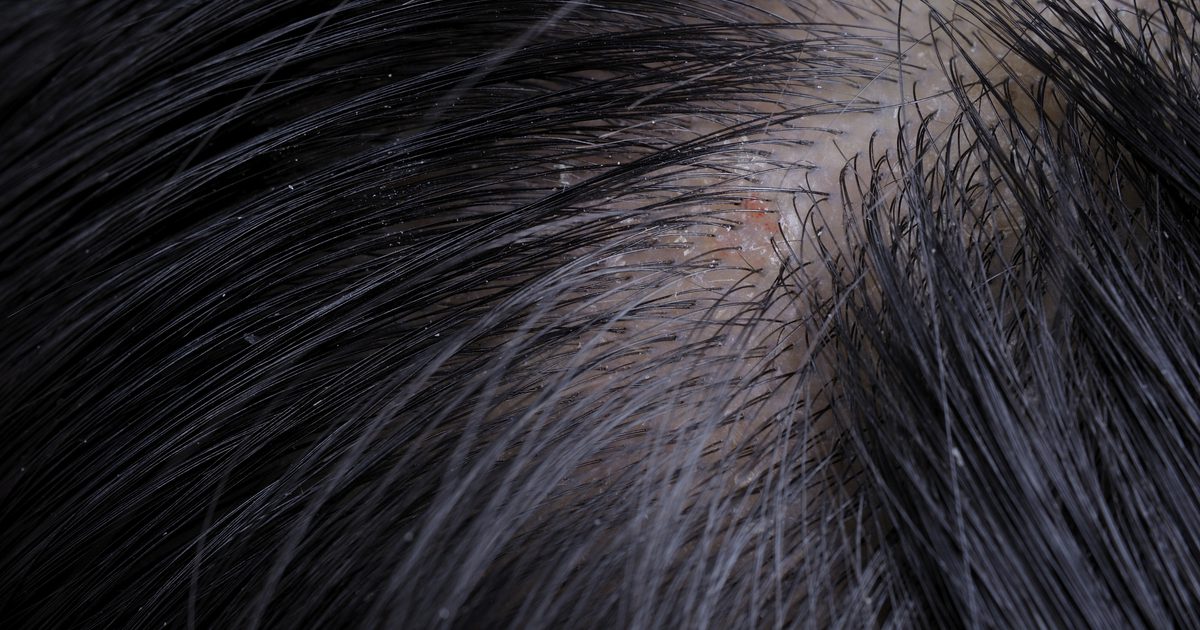 Können Aminosäuren gesundes Haarwachstum fördern?