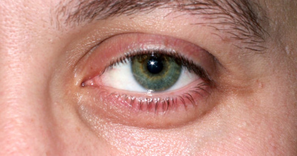 Kan øyeøvelser redusere puffy eyes?