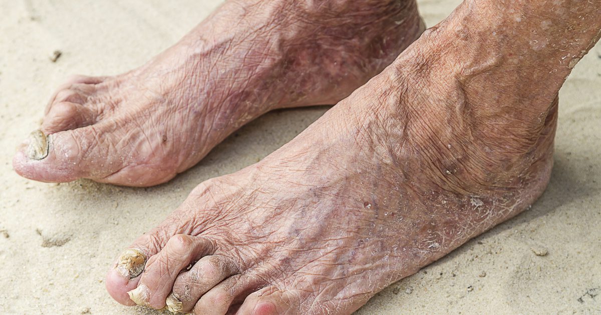 Ali lahko peroksid zdravi gnoj za nohte?
