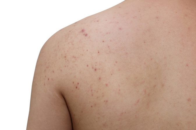 Årsager til acne på armene og ryggen
