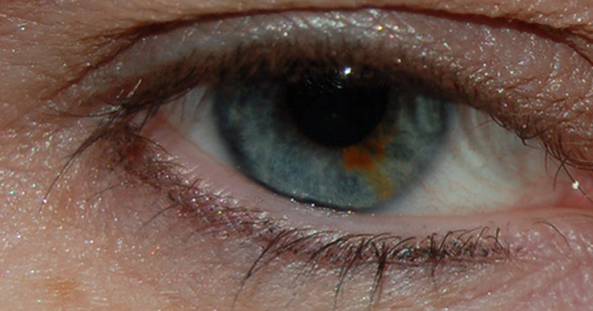 Dunkle Flecken auf dem Weiß des Auges