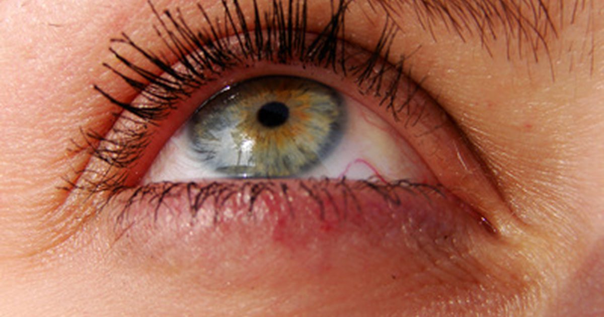 Dermatologe Entfernung von Augenringen um das Auge