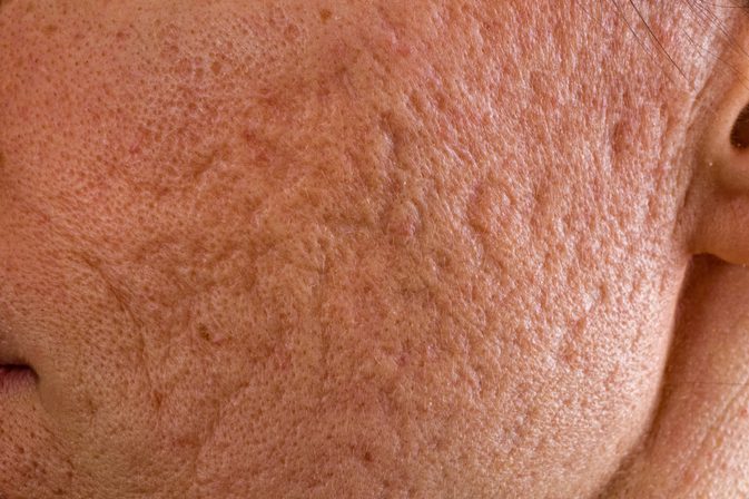 Glycolzuurbehandelingen voor acne littekens