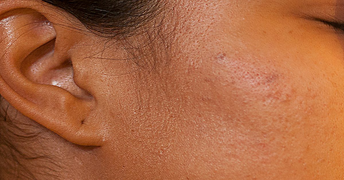 Hvordan Fade Dark Acne Spots