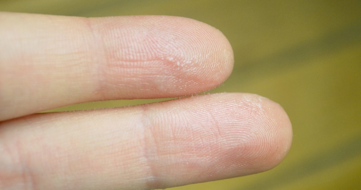 Hur man får nagel lim av din hud