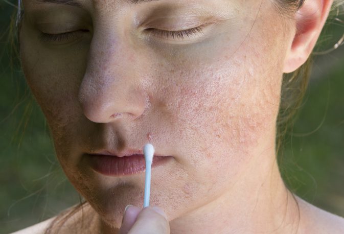 Как да се отървете от алергичните реакции на лицето, като блеми или пъпки