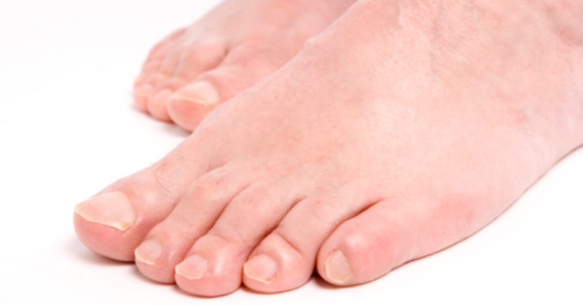 Ako sa zbaviť neporiadenej nohy nechtov