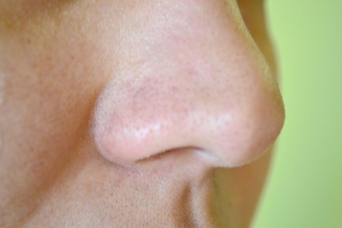 Kako odstraniti črne glave na nosu, ne da bi zapustili luknje