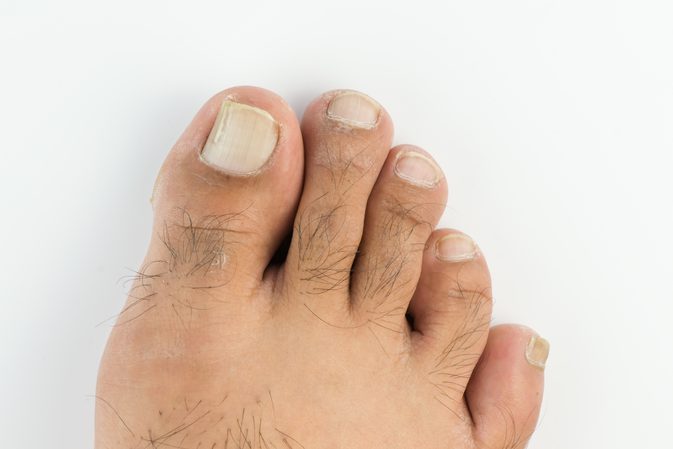 Hvordan slippe af med tørre fødder og grimme toenails
