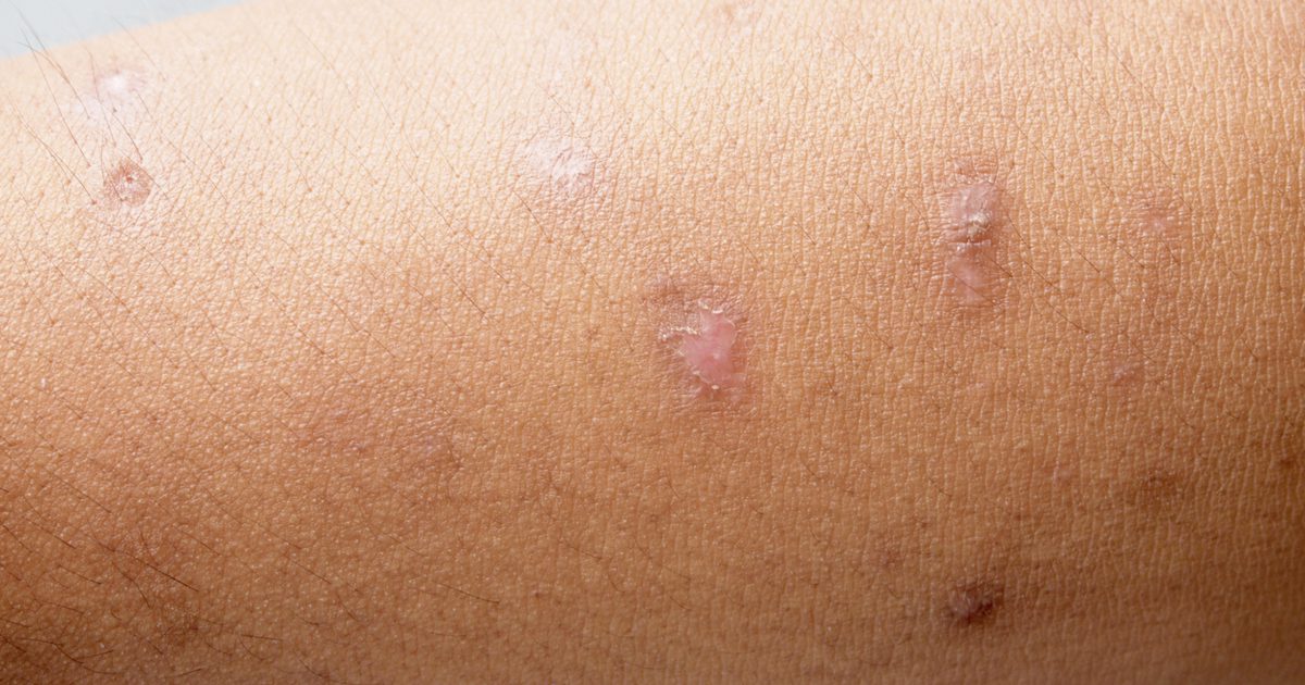 Hoe zich te ontdoen van littekens van Hives