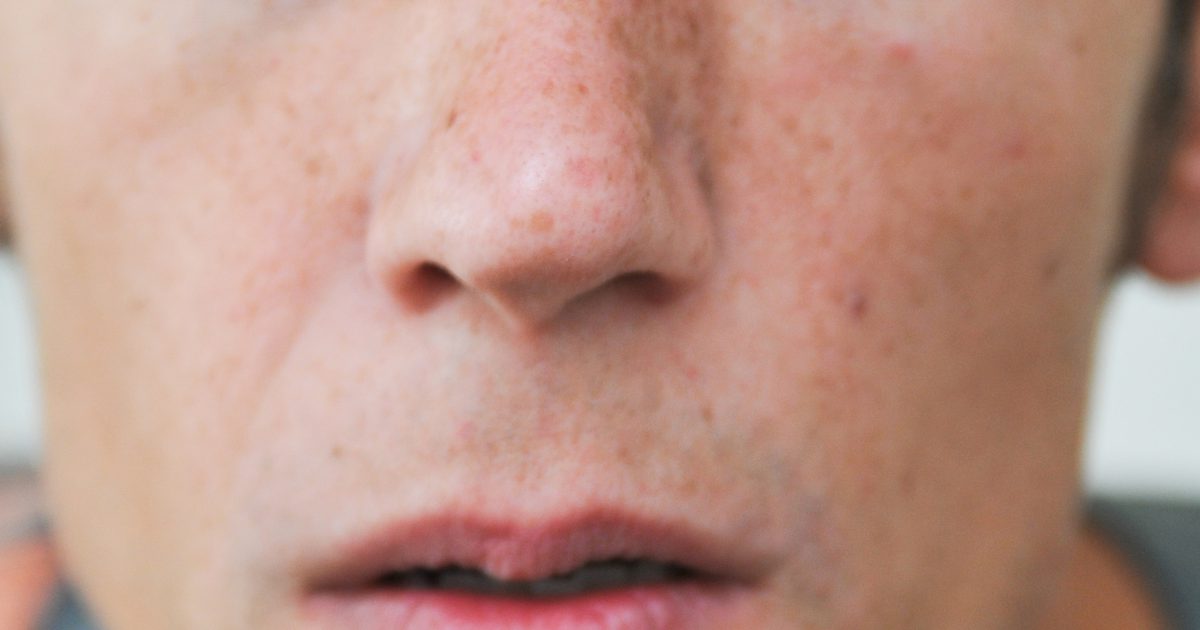 Как да намалим зачервяването около носа