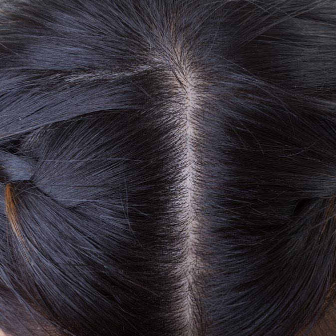 Kako odstraniti brazgotine las