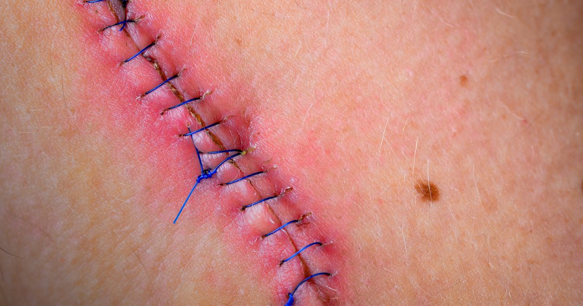 Hvordan du forteller om en sutur arr er healing godt