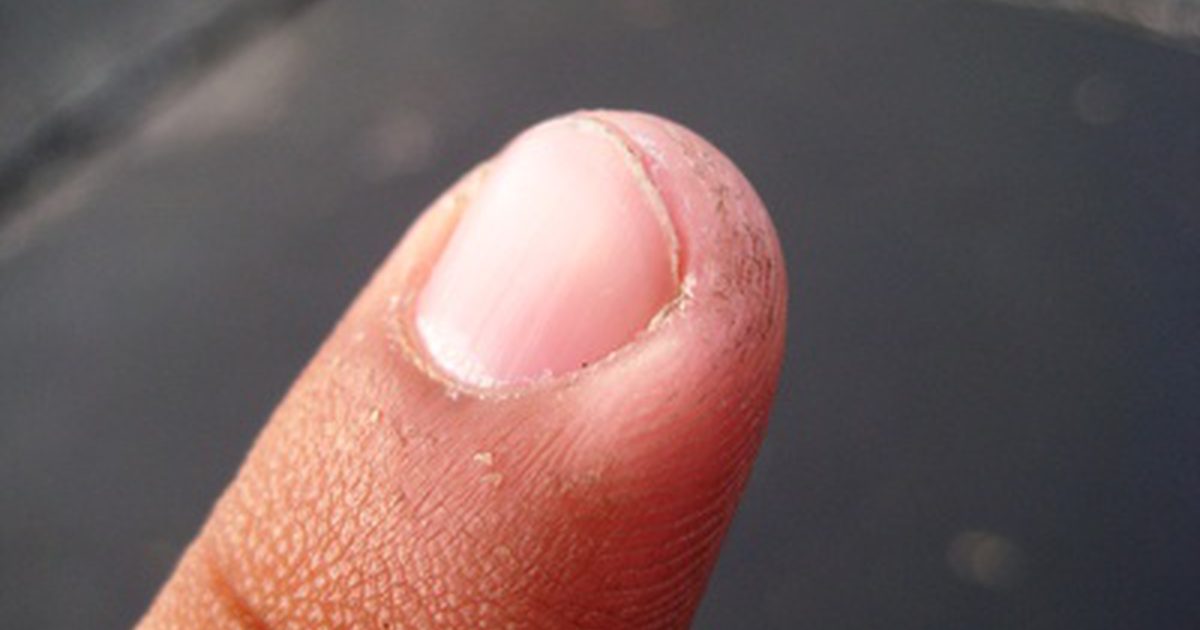 Hvordan man behandler en indgroet fingernegle