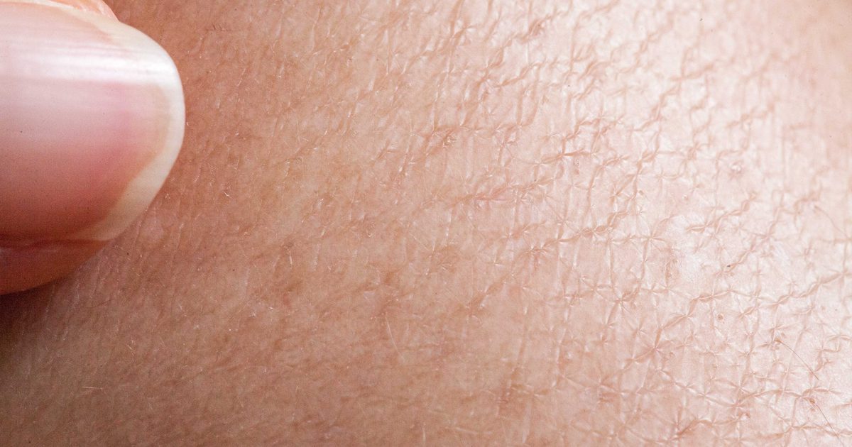 Naturlige Remedies for ekstremt tør hud