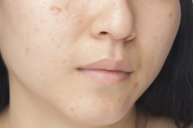 Fet hud och stora porer