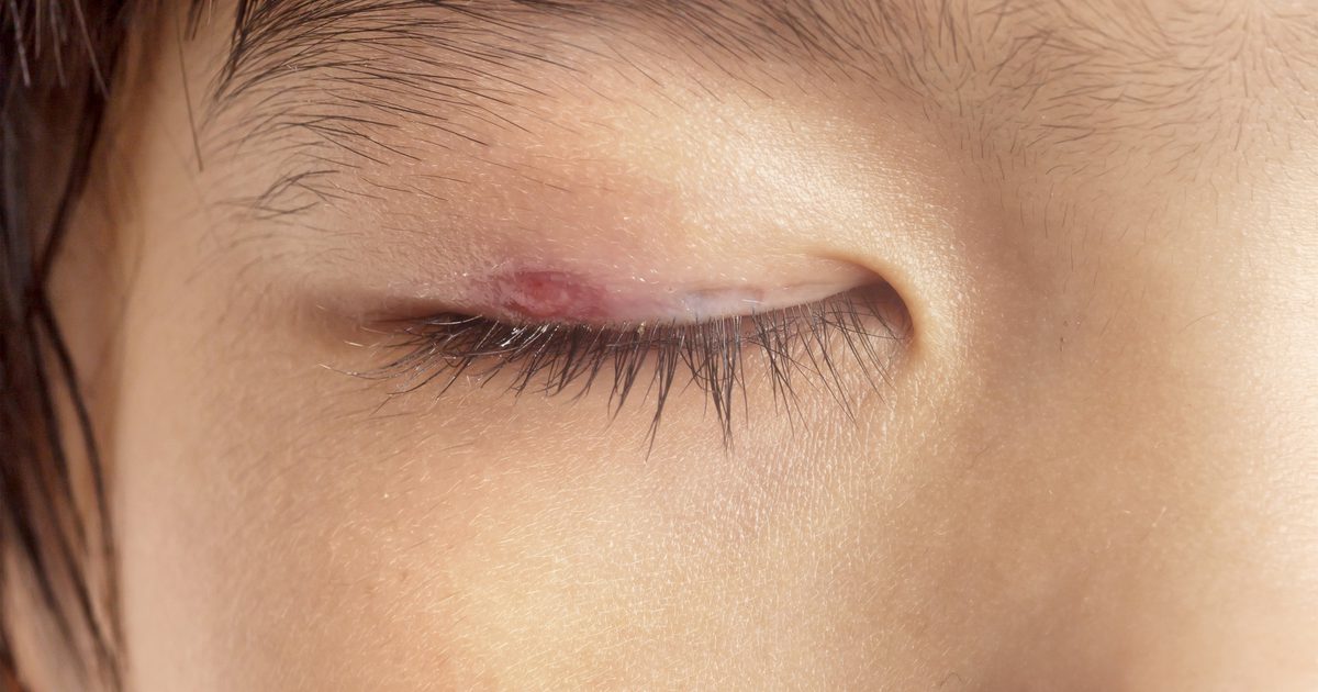 En pimple med inflammation runt ögat