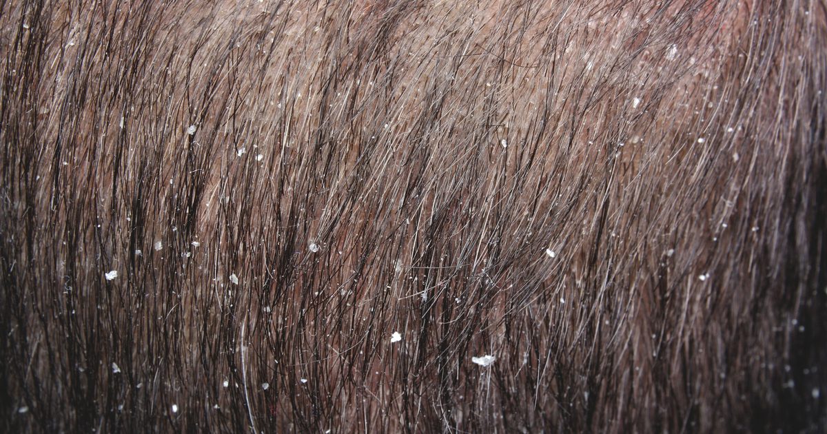 Tipy pro odstranění lupů z vlasů