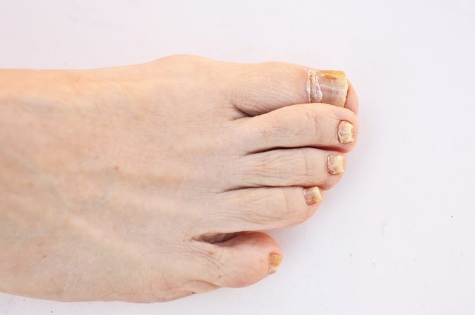 Какви са причините за обезцветяване на нокътя на нокът?