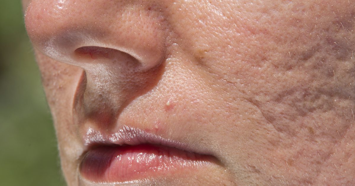 Pimples Popping के खतरे क्या हैं?