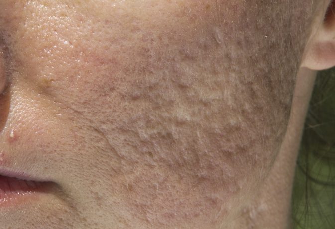 Hvad ser acne kratere ud?