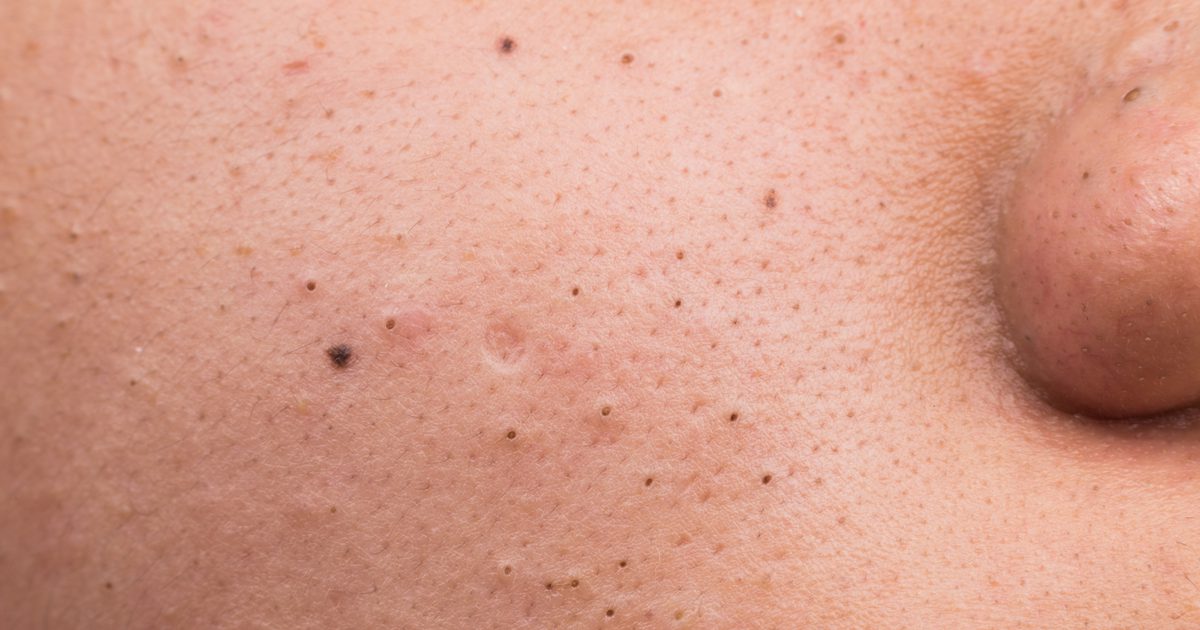 Wat is het verschil tussen verstopte poriën en acne?