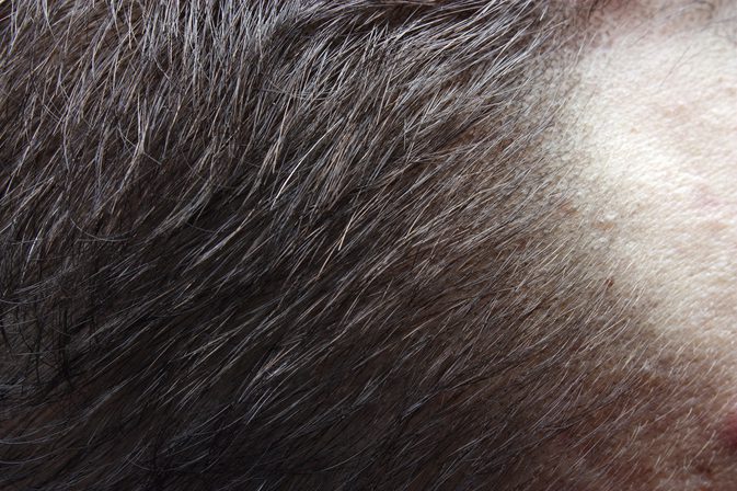 Alopecie a laktóza