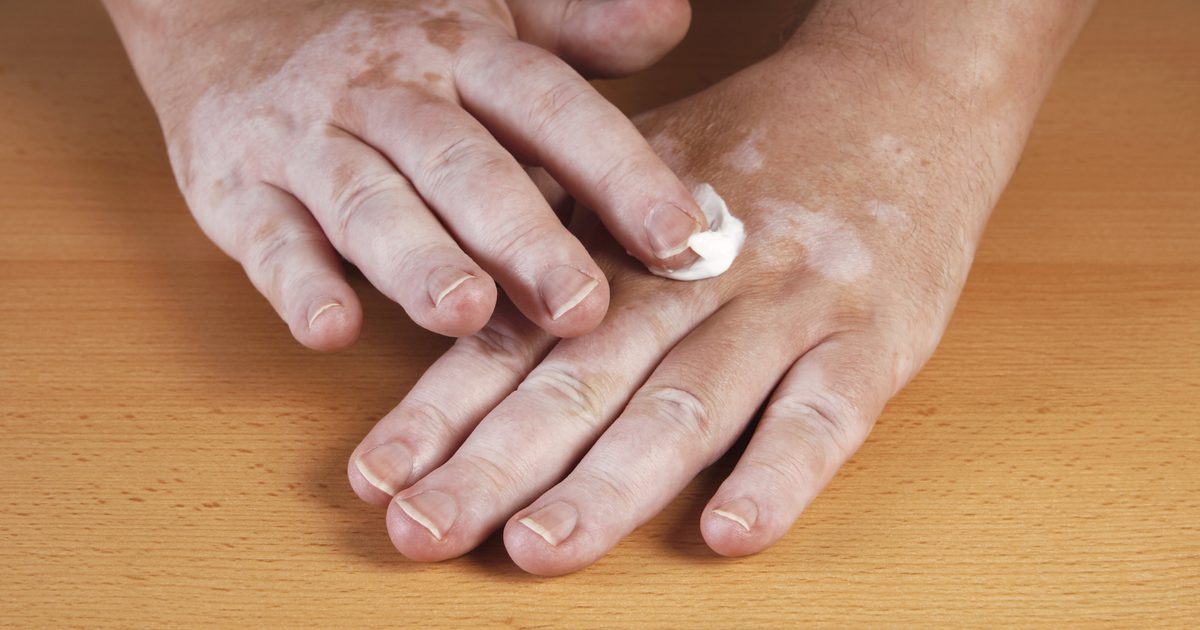 Černý pepřový olej pro vitiligo