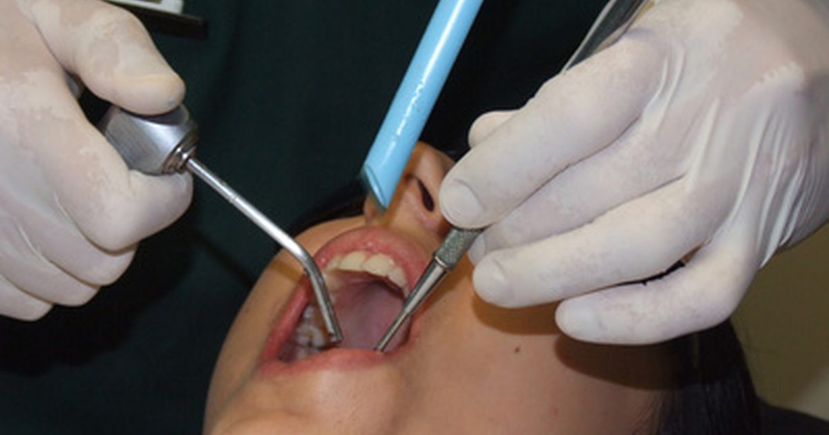 Zubné extrakčné vedľajšie účinky