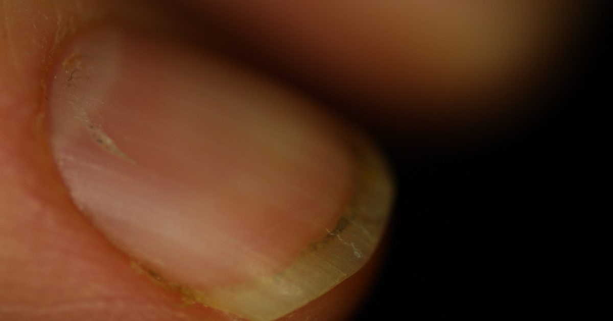 Verursachen Vitamin-Mängel Fingernagel-Kanten?