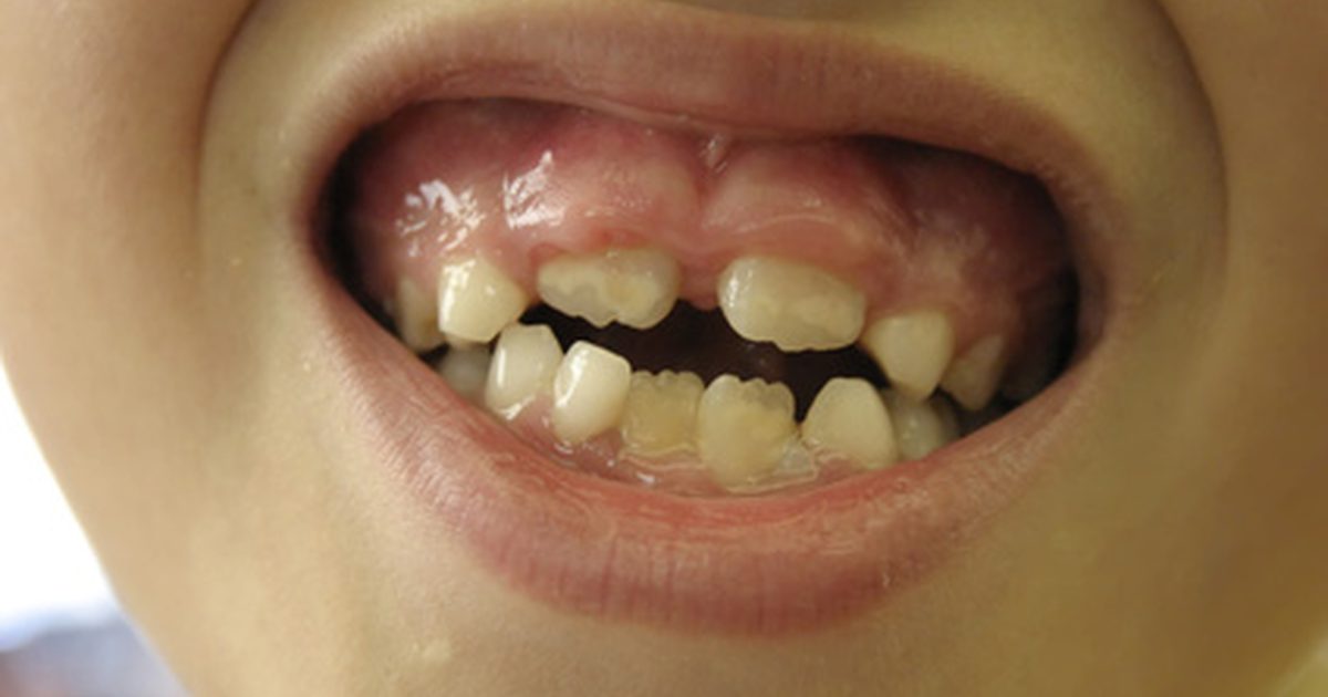 Welke vitaminetekorten veroorzaken opgezwollen tandvlees?