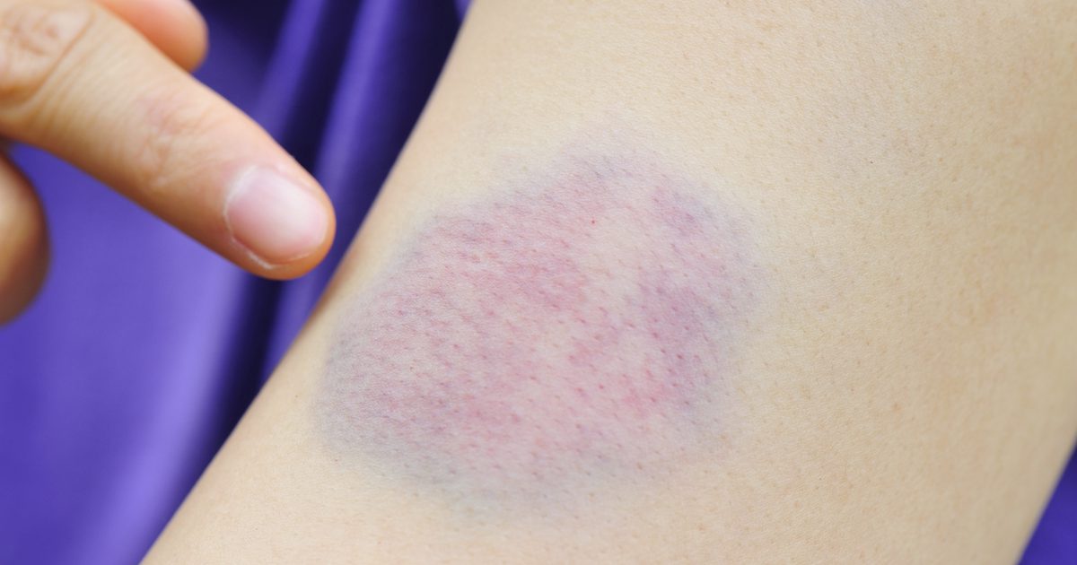 Sådan fjerner du Bruise Marks