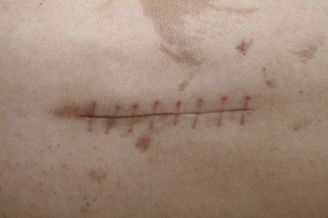 Hoe littekens na een operatie te behandelen
