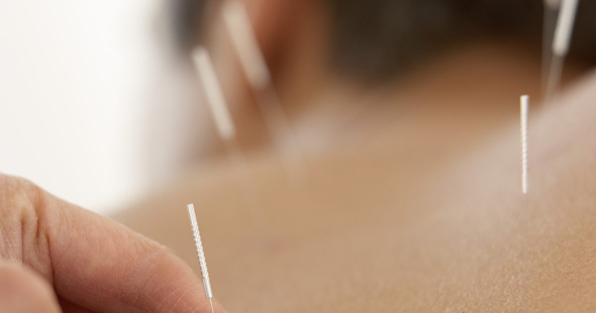 Is Bruising Normal met acupunctuur behandelingen?
