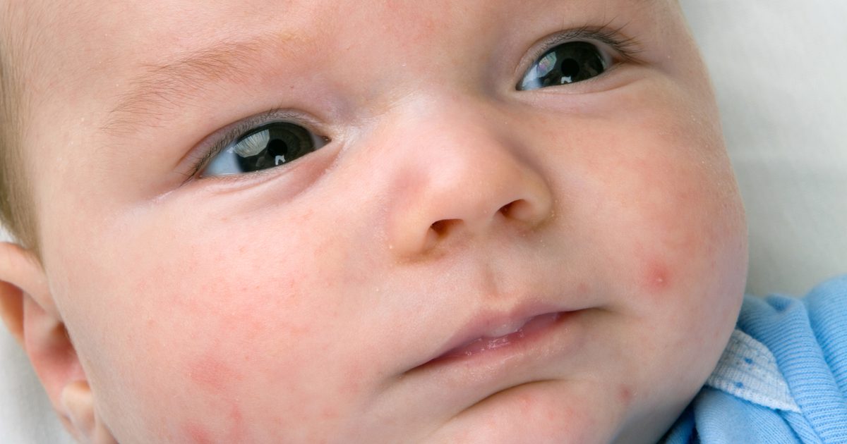 Natürliche Heilmittel für Baby Akne
