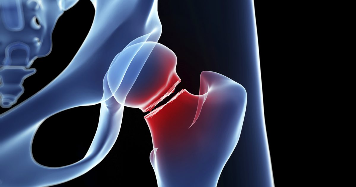 Fysiotherapie Behandelingen van een femurfractuur van het dijbeen
