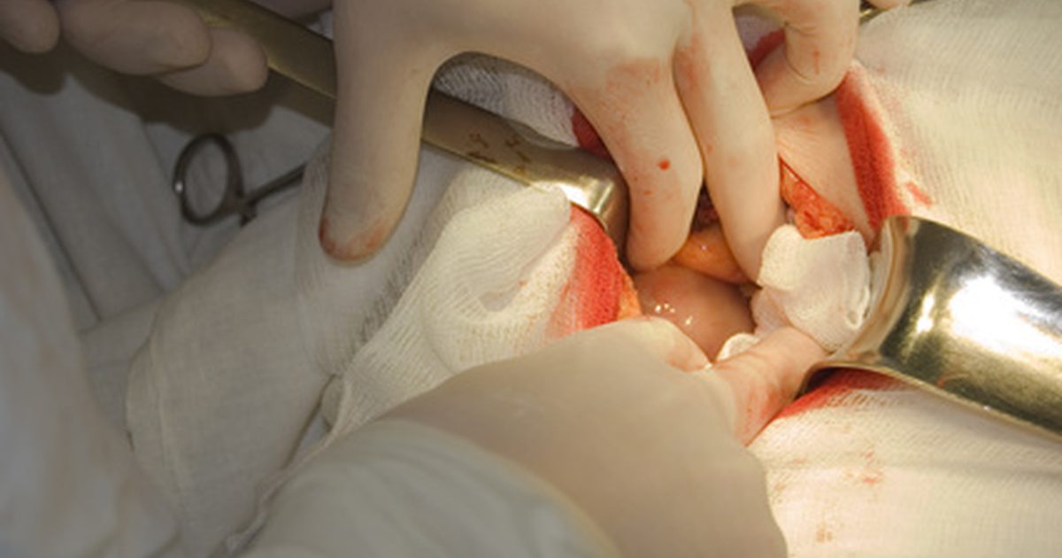 Postoperatieve complicaties van Abdominal-Hernia-chirurgie
