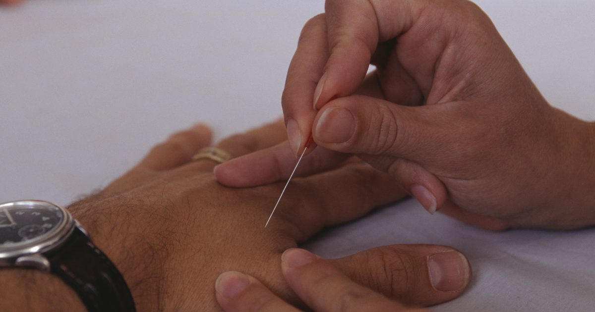 Tippning och nummenhet under akupunktur