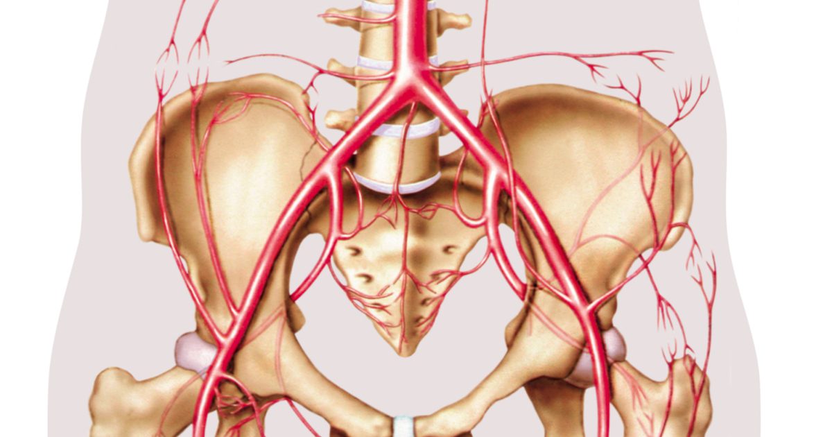 Hva er tegn og symptomer på å dissect Iliac Artery Aneurysm?