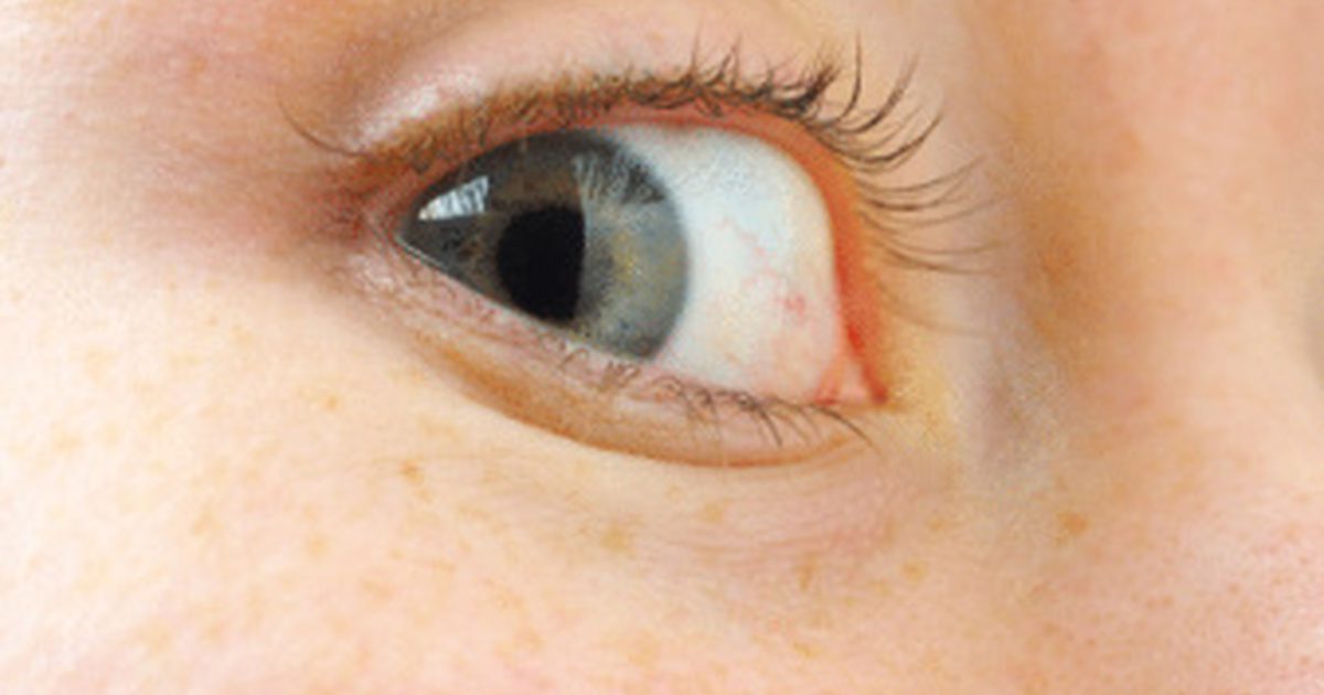 Biały guzek po wewnętrznej stronie oka